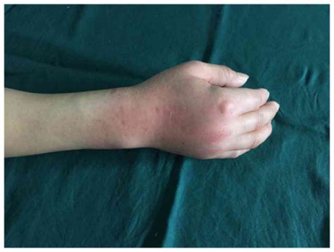 Treatment of gout combined with Kienböck's disease: A case report