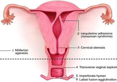 Uterine Synechiae: Introduction, Symptoms, Causes and Treatment