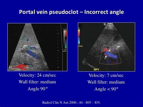 Doppler ultrasound of portal vein thrombosis