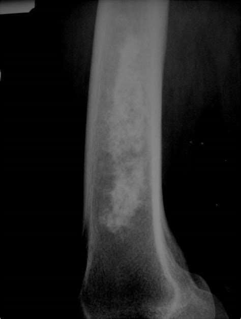 Enchondroma : Benign Bone Tumor: Tumors of Bone