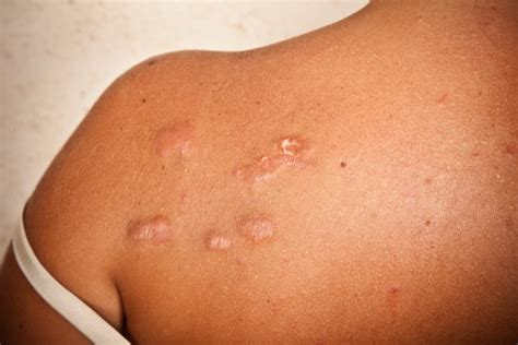 Black Skin Care 101: What Are Keloid Scars and How Do Black Women You Get Rid of Them? - Essence