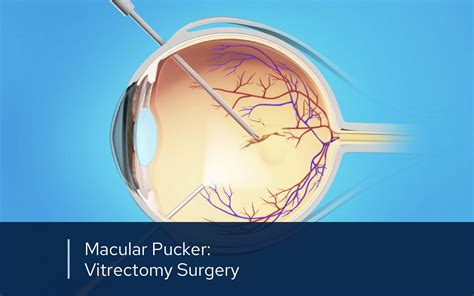 Retinal Videos | Retinal Consultants Medical Group