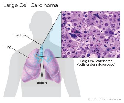 Large Cell Lung Cancer | LUNGevity Foundation