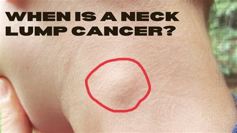 Could My Neck Lump Be Cancer Such as Lymphoma? - YouTube