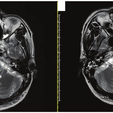 (A) MRI scan following two cycles of comprehensive chemotherapy and... | Download Scientific Diagram