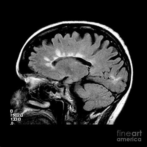 Multiple Sclerosis Brain Mri With Lesions - vrogue.co