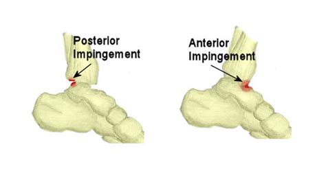 Ankle Impingement - Symptoms, Causes, Treatment & Rehabilitation