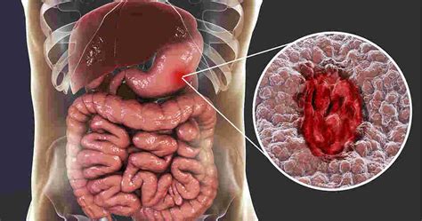 Stomach Ulcers: Causes, Types, Symptoms, & Treatment