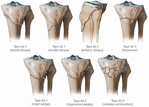 Extra-Articular Proximal Tibial Fractures: Submuscular Locked Plating | Musculoskeletal Key