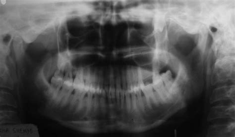 Panoramic radiograph of the patient | Download Scientific Diagram