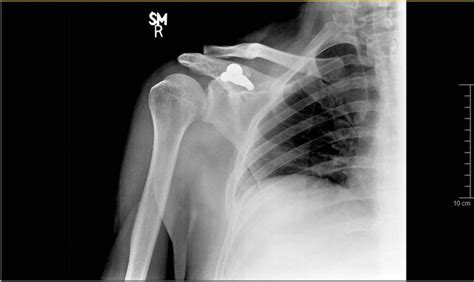 An Isolated Displaced Fracture of the Coracoid Process Treated with Osteosynthesis—A Case Report ...