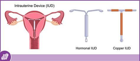 IUD Insertion and Removal Doctor Near Me in Austell, GA