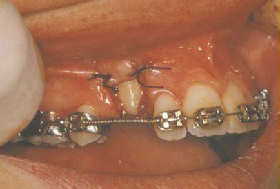 Impacted Teeth | Georgia | South Oral & Maxillofacial Surgery