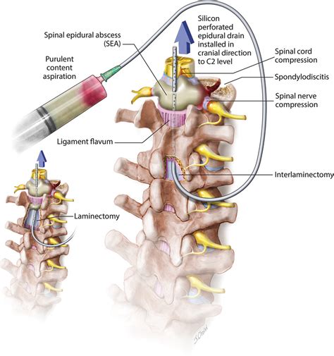 Surgical management of an extensive spinal epidural abscess: illustrative cases in: Journal of ...