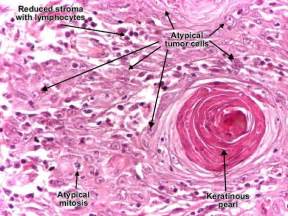 squamous cell carcinoma histology - Google Search | PATHOLOGY | Pinterest | Search