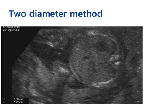 8. normal second trimester ultrasound