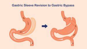 Gastric Sleeve Revision to Gastric Bypass: Is it A Right Option?