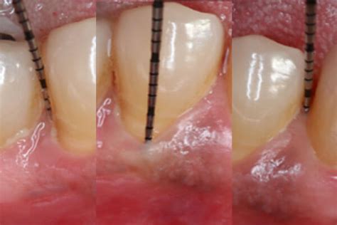 Stages of Periodontal Disease | Bayside Periodontics & Dental Implants