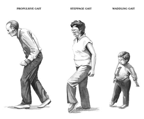 Propulsive Gait - Steppage Gait - Waddling Gait | Abnormal, Medical ...