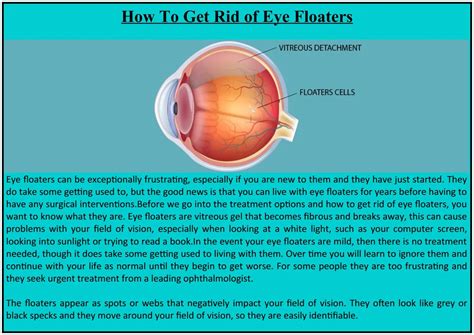 How To Get Rid of Eye Floaters by Mahi Muqit - Issuu