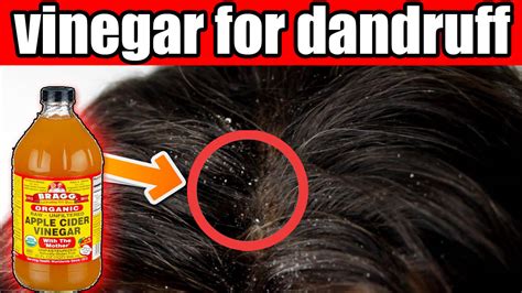 Best Ways To Use Apple Cider Vinegar For Dandruff Treatment - Natural ...