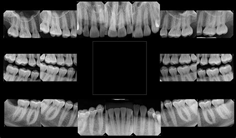 Digital X-Rays | Buffalo Grove, Illinois | Drs. Papworth and Vargas Family Dentistry