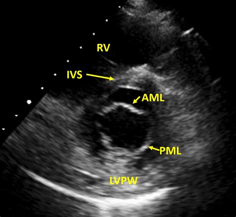 Normal mitral valve cross section on echocardiography – All About ...