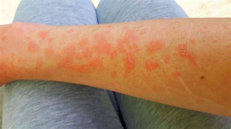 What Does Sun Allergy Rash Look Like? See These Pictures