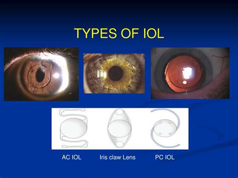 PPT - PROBLEMS OF APHAKIA & IOL PowerPoint Presentation, free download - ID:6184077