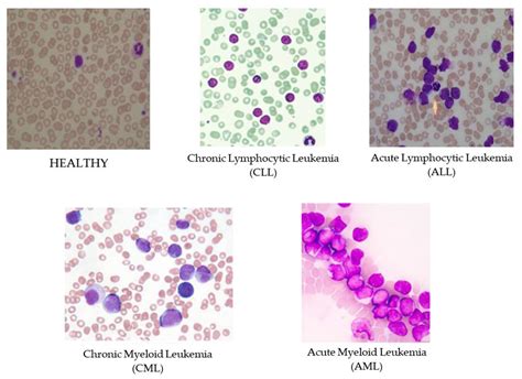 Acute Myeloid Leukemia Histology