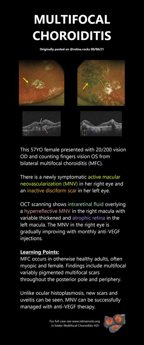 Inflammatory Disorders > Multifocal Choroiditis - Retina Rocks