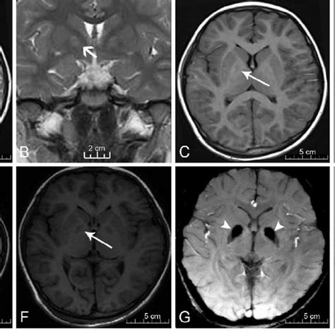 Globus pallidus-related MRI findings of PKAN. | Download Scientific Diagram