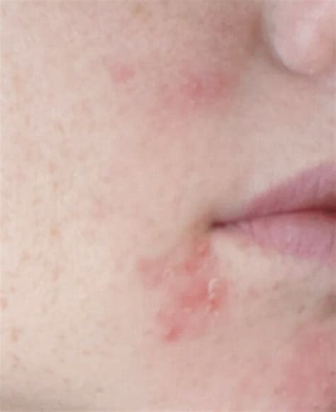 Help, dry but spotty patches on face | Mumsnet