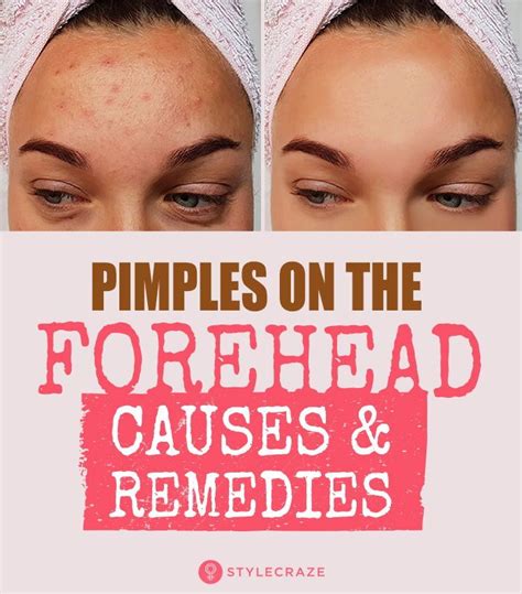 How To Get Rid Of Pimples On Forehead | Pimples on forehead, Forehead acne, Forehead acne cause