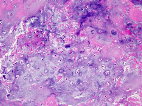 Multiple Enchondromatosis Histology