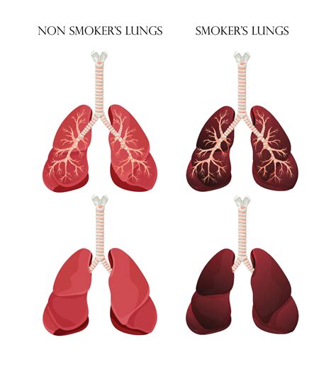 Illustration of normal healthy lungs and lungs smoker. Concept of stop ...