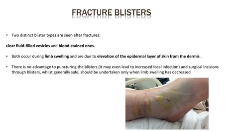 PPT - Complications of fractures PowerPoint Presentation, free download ...