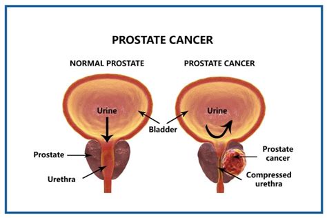 Prostate Cancer Treatment in Cumming, GA | Bhalani Urology