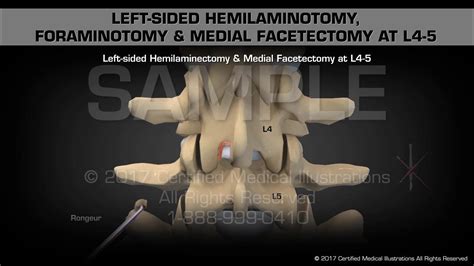 Left-sided Hemilaminotomy, Foraminotomy & Medial Facetectomy at L4-5 ...