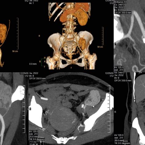 Abdomen and pelvis CT scan 6 months after surgery (the kidney seem to... | Download Scientific ...