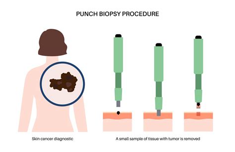 Punch Biopsy: Purpose, Preparation, Risks, and Results