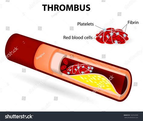 3,149 Thrombus 图片、库存照片和矢量图 | Shutterstock