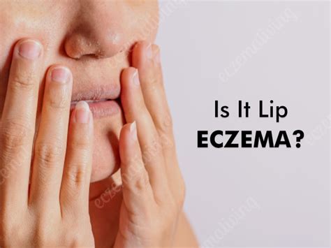 Eczema on Lips - Causes, Symptoms, Treatment & Home Remedies