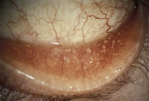 There's a Growth on My Eyelid: Conjunctival Concretions - Eyedolatry