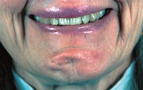 Botulinum Toxin A for Mentalis Muscle Dysfunction | Dermatology | JAMA Facial Plastic Surgery ...