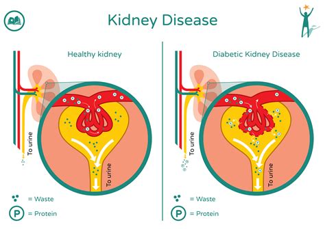 Diabetes and the Kidneys | MyWay Diabetes Somerset