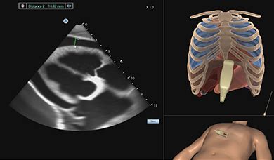 Pericardiocentesis Ultrasound Module - Surgical Science