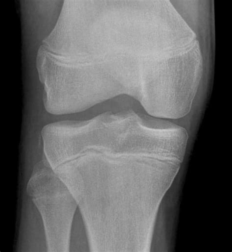 Segond fracture • LITFL Medical Blog • Medical Eponym Library