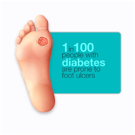 Diabetic Foot Ulcers Risk Factors Symptoms Treatment