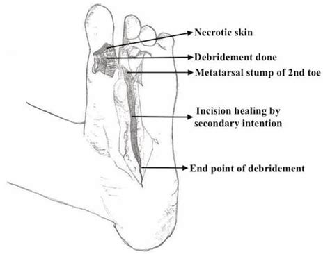 Cureus | Ray Amputation in a Traumatic Diabetic Foot